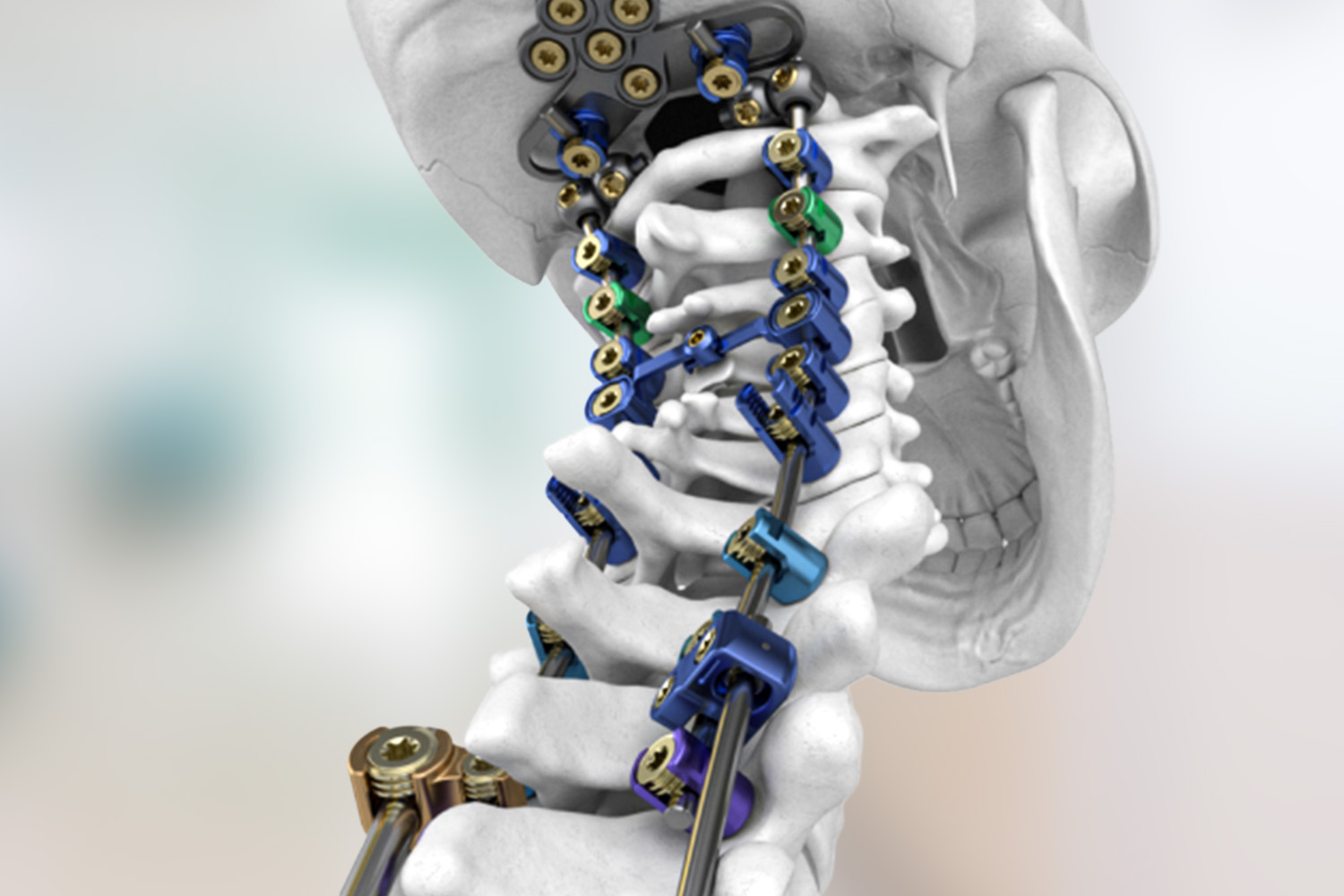 Complex Cervical Reconstruction