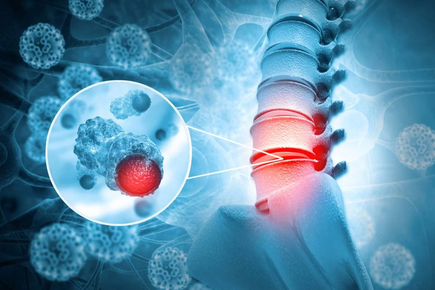 Spinal Infections