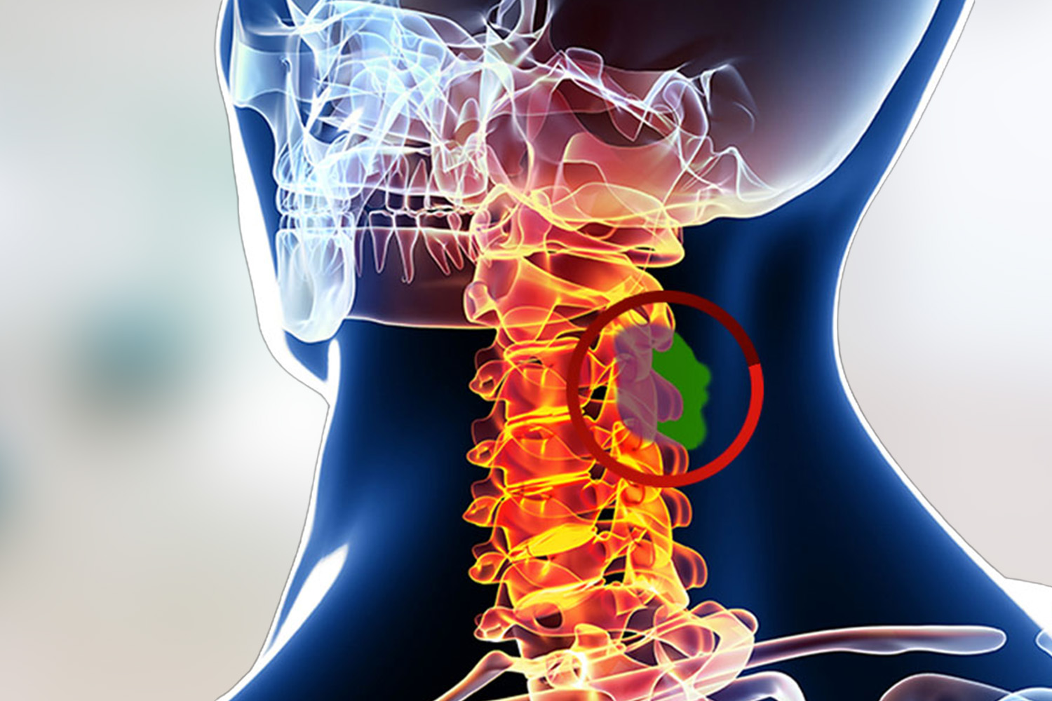 Spinal Tumours