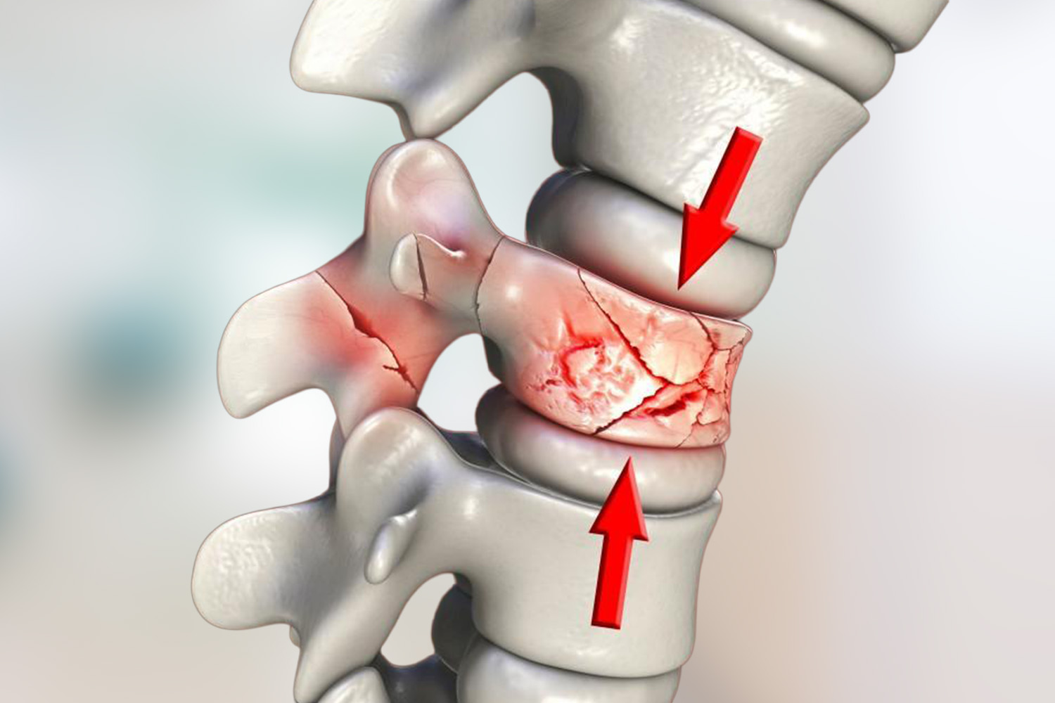 Spinal & Vertebral Fractures